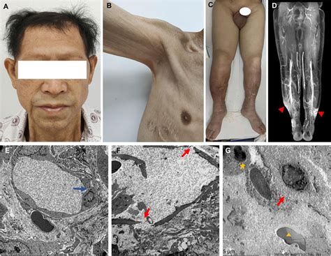 kapillarlecksyndrom symptome|Capillary leak syndrome